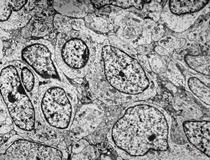 F,8y. | medulloblastoma